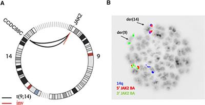 Case Report: Whole genome sequencing identifies CCDC88C as a novel JAK2 fusion partner in pediatric T-cell acute lymphoblastic leukemia